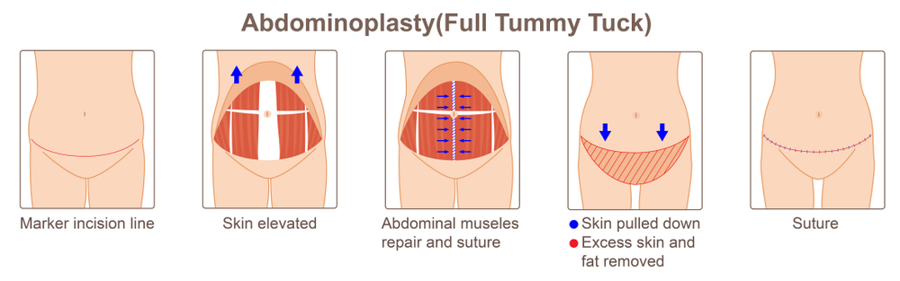 what is a tummy tuck or abdominoplasty in nashville