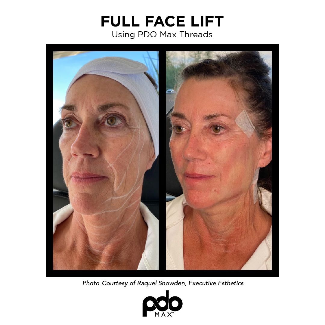 full facelift with PDO threads 