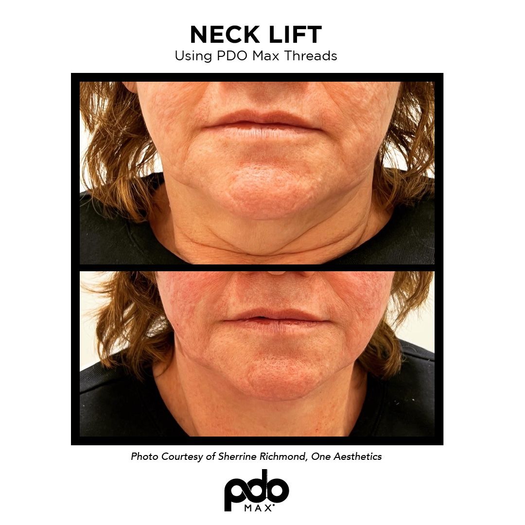 neck lift with PDO threads 