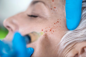 prp facial rejuvenation nashville vampire facial treatment