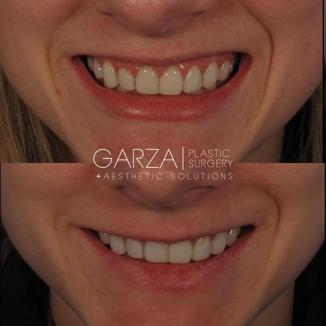 botox for a gummy smile before and after pictures