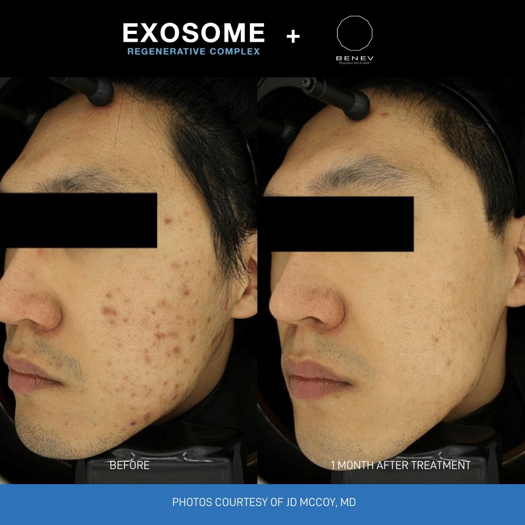 exosomes for acne scarring