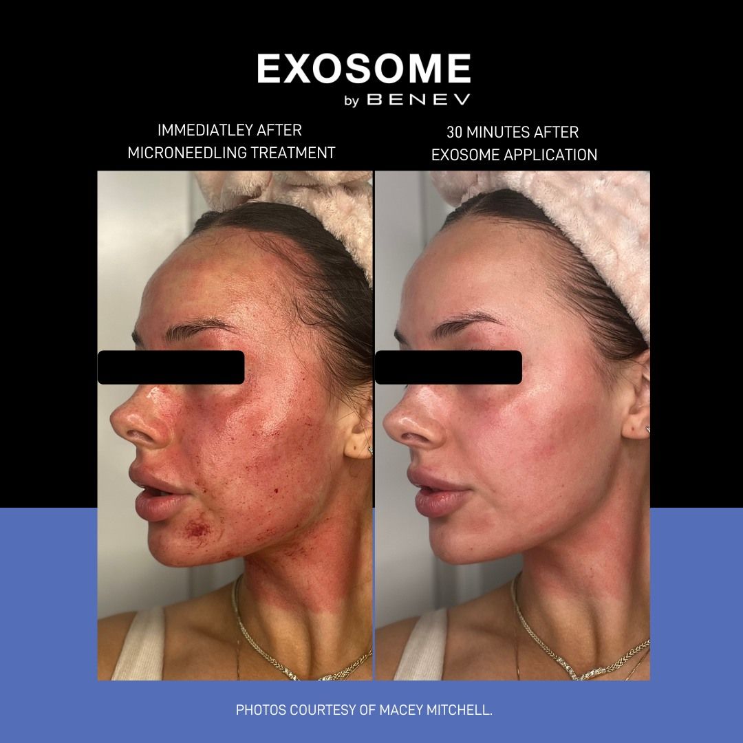 faster healing after microneedling with exosome treatments to replace PRP