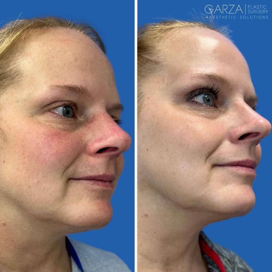 image before and after 1 IPL treatment in nashville
