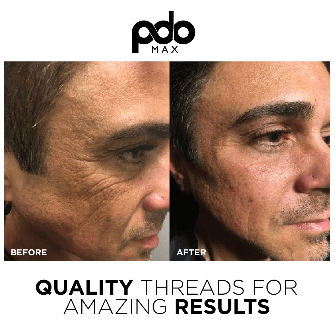 pdo threading nashville before and after wrinkle treatment for men