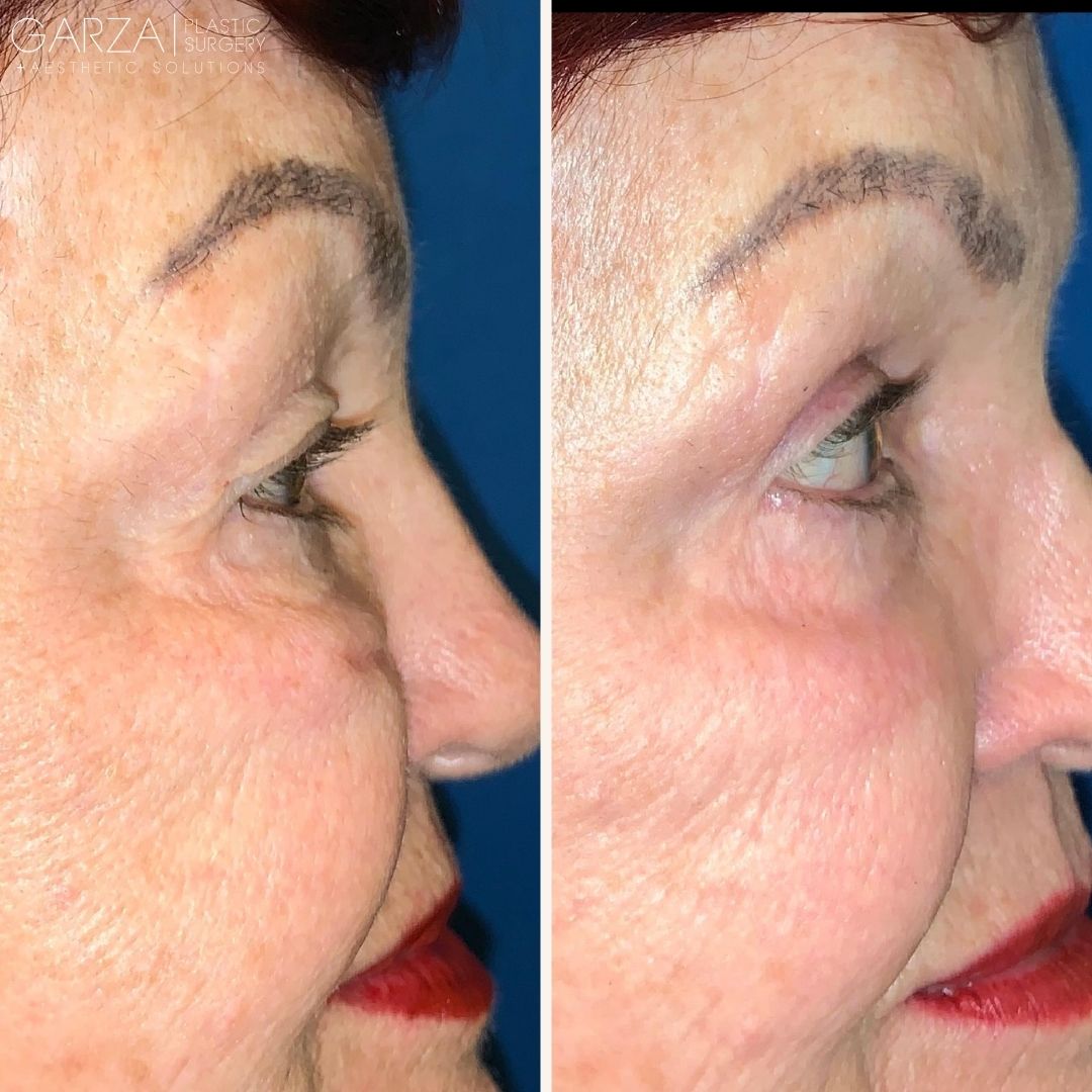 upper eyelid surgery before and after pics in nashville