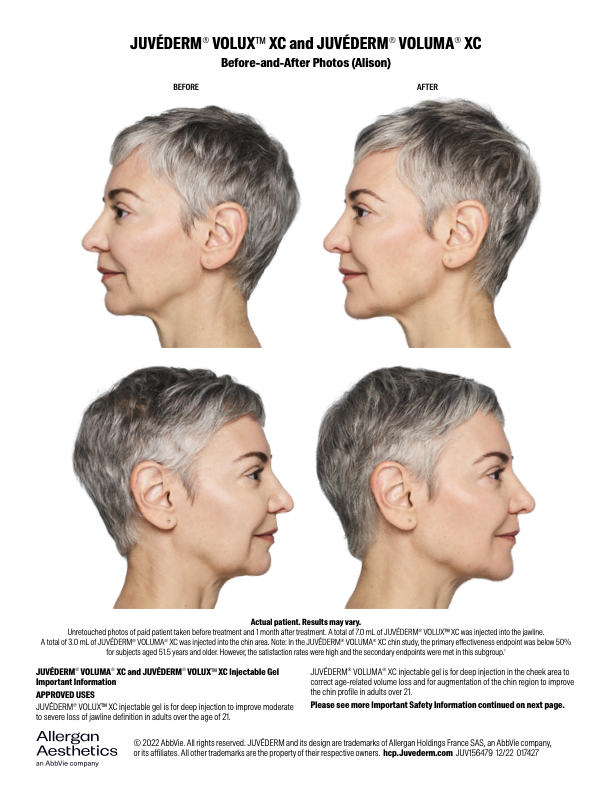 a new jawline filler in nashville for a more defined look and feel