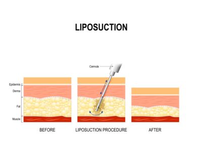 how does lipo work, liposuction treatment in nashville